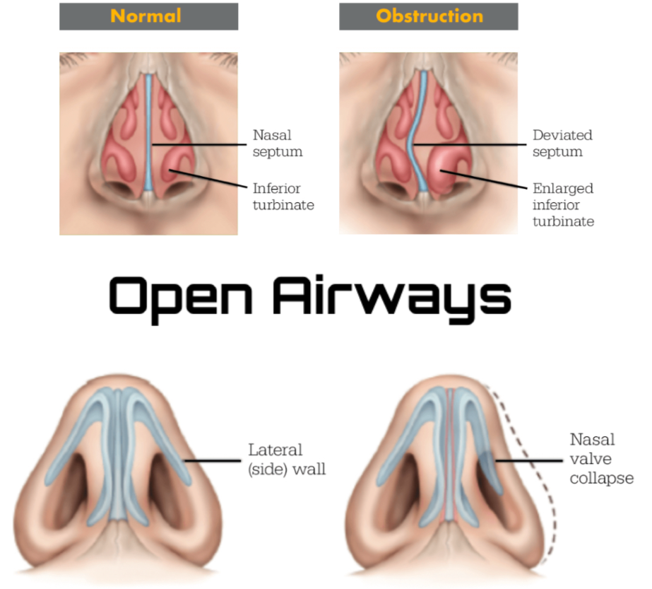 -Nose Breather || Airway Expander for Improved Sleep and Exercise