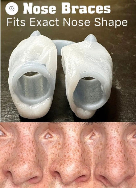 Moldable custom nose vent kit to help you sleep and fix a deviated septum