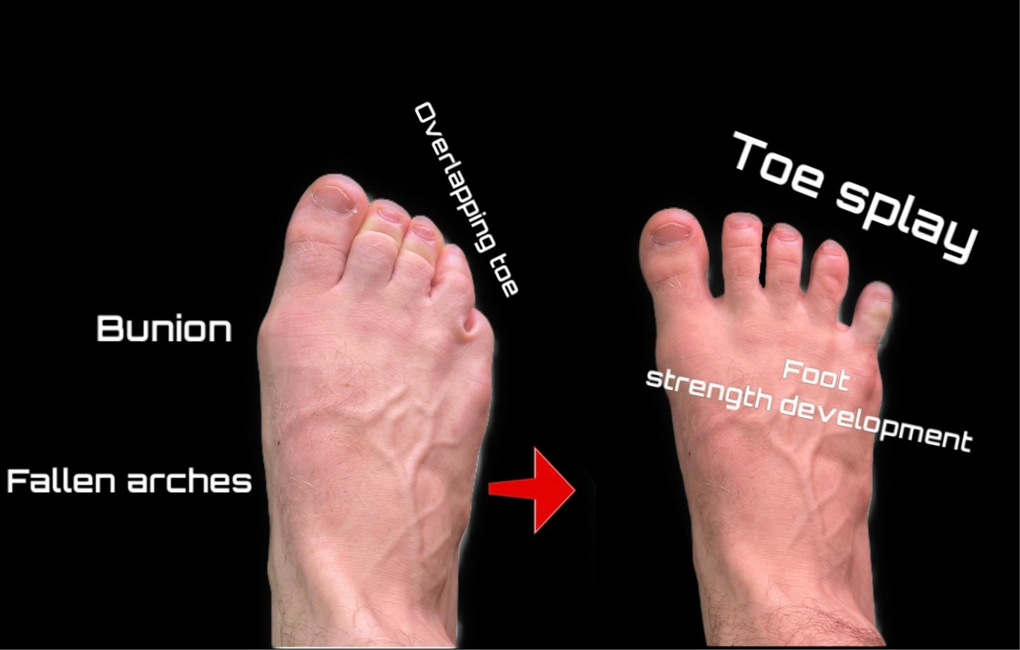 -Customizable Toe Splay Trainer Kit with Training Program Included