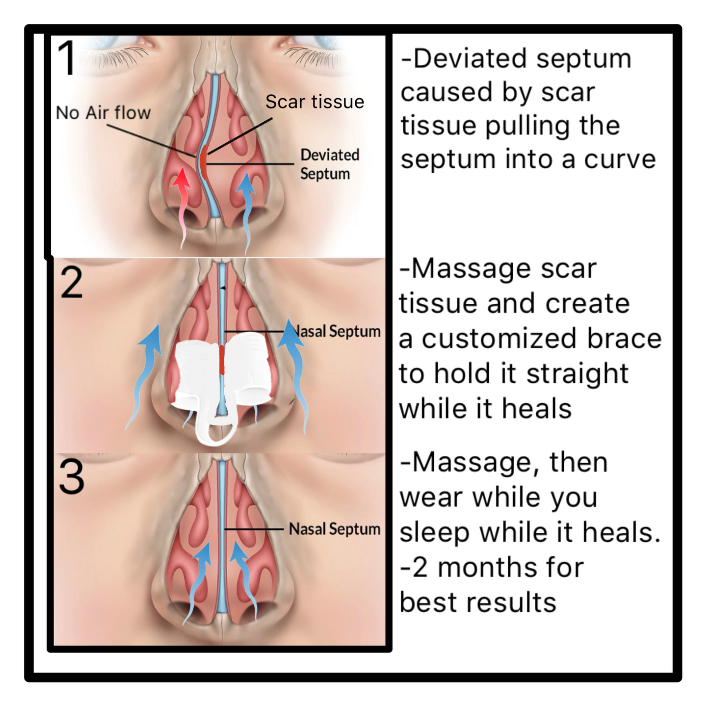 Custom nose vent kit to help you sleep and fix a deviated septum