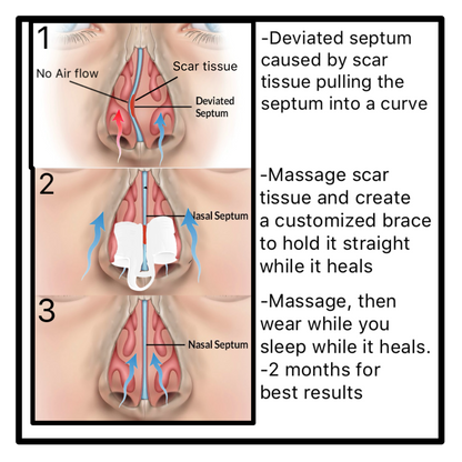 Moldable custom nose vent kit to help you sleep and fix a deviated septum